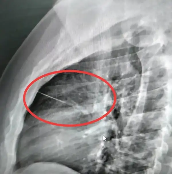 ภาพข่าว บุรีรัมย์ หนุ่มเพลียทิ้งตัวลงที่นอนเจอเข็มเย็บผ้าซ่อนอยู่เสียบมิดเฉียดหัวใจสาหัส - TIGER NEWS REPORT